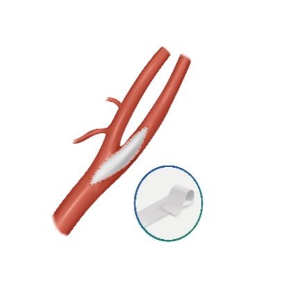 佰维思® 血管生物补片